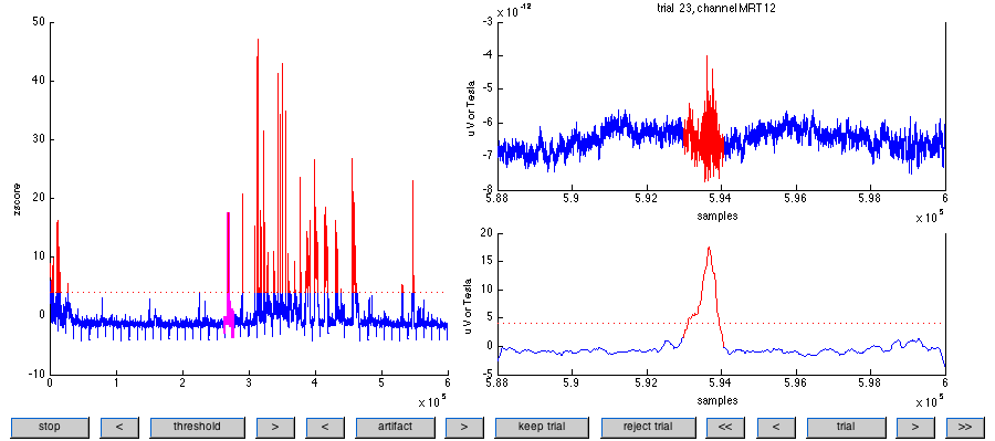 可以在通道 MRT12，试次 32 上观察到典型的肌肉伪影。